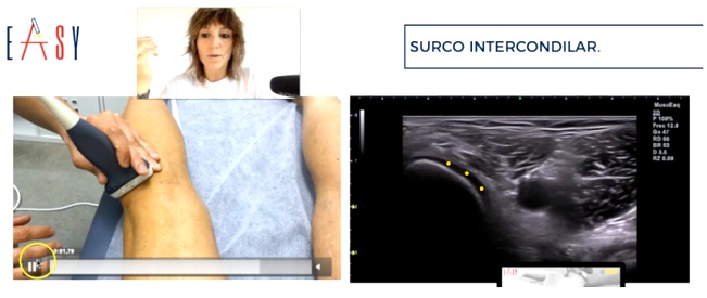 La ecografía en la artrosis de rodilla, permite obtener imágenes de esta enfermedad degenerativa de las articulaciones que afecta principalmente al cartílago