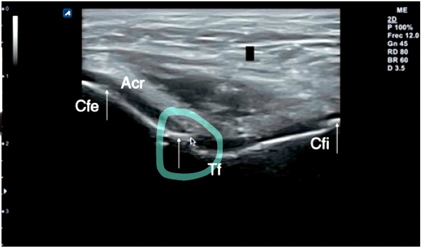 La ecografía en la artrosis de rodilla, permite obtener imágenes de esta enfermedad degenerativa de las articulaciones que afecta principalmente al cartílago