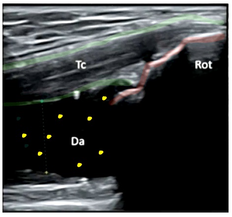 La artrosis de rodilla, también conocida como osteoartritis de rodilla, es una enfermedad degenerativa de las articulaciones 