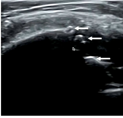 La artrosis de rodilla, también conocida como osteoartritis de rodilla, es una enfermedad degenerativa de las articulaciones 