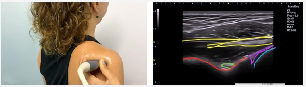 Corte de referencia en ecografía del labrum posterior del hombro