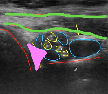 Ecografía del un labrum con quistes