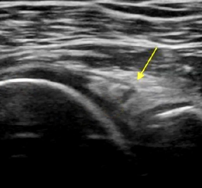 Ecografía del labrum