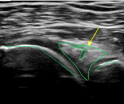 Ecografía del labrum