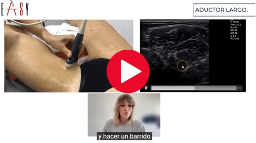 La articulación acromioclavicular es una articulación prácticamente plana cuya función principal es realizar ajustes durante la báscula escapular para que el movimiento de nuestro hombro sea congruente