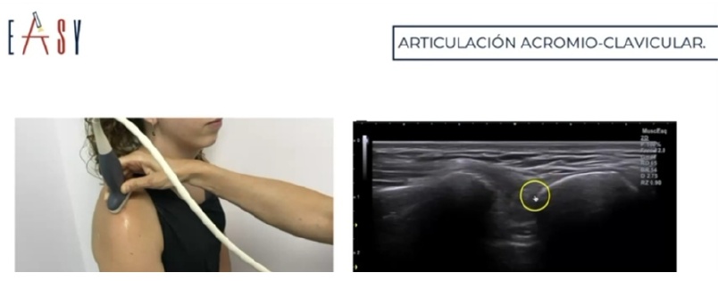 La articulación acromioclavicular es una articulación prácticamente plana cuya función principal es realizar ajustes durante la báscula escapular para que el movimiento de nuestro hombro sea congruente La articulación acromioclavicular es una articulación prácticamente plana cuya función principal es realizar ajustes durante la báscula escapular para que el movimiento de nuestro hombro sea congruente
