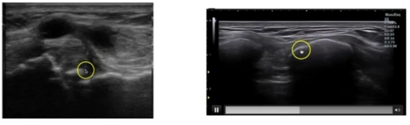 La articulación acromioclavicular es una articulación prácticamente plana cuya función principal es realizar ajustes durante la báscula escapular para que el movimiento de nuestro hombro sea congruente La articulación acromioclavicular es una articulación prácticamente plana cuya función principal es realizar ajustes durante la báscula escapular para que el movimiento de nuestro hombro sea congruente