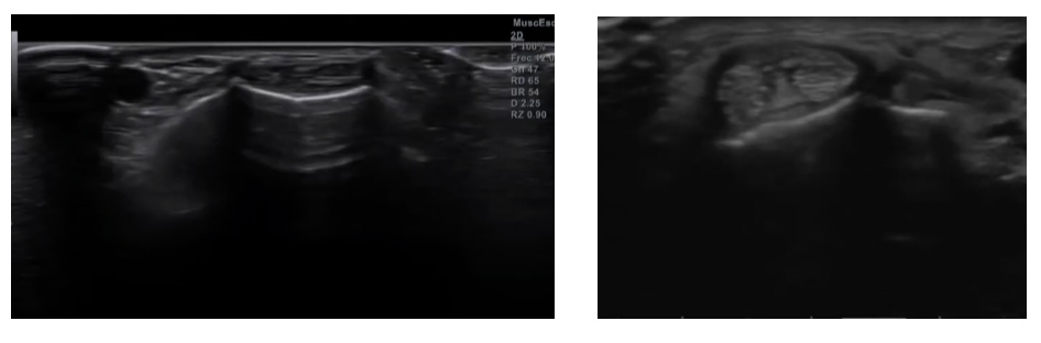 
Síndrome de intersección de la mano, qué es y cómo se manifiesta. Debes conocer la anatomía de la región dorsal y el diagnósitco diferencial con la Tenosinovitis de Quervain