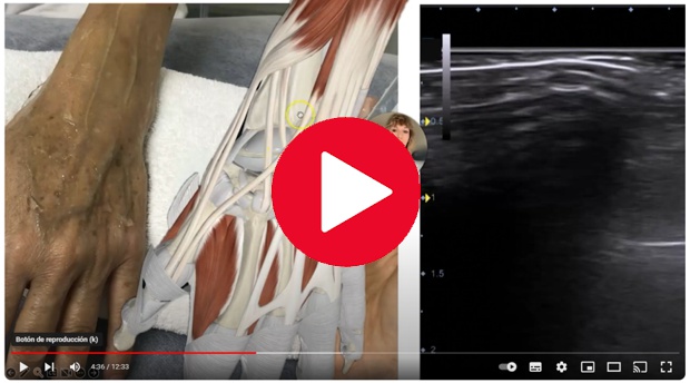 
Síndrome de intersección de la mano, qué es y cómo se manifiesta. Debes conocer la anatomía de la región dorsal y el diagnósitco diferencial con la Tenosinovitis de Quervain