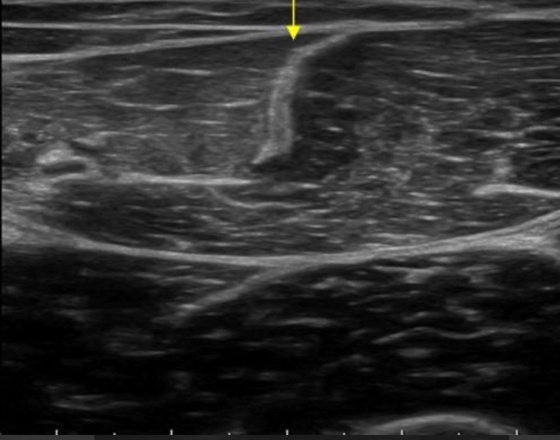 El recto anterior o femoral es uno de los cuatro fascículos musculares que componen el cuádriceps. Veamos anatomía y ecografía