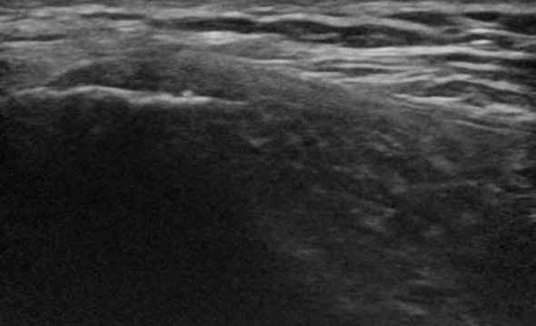 Ecografía de la cintilla iliotibial sana Ecografía de la cintilla iliotibial sana
