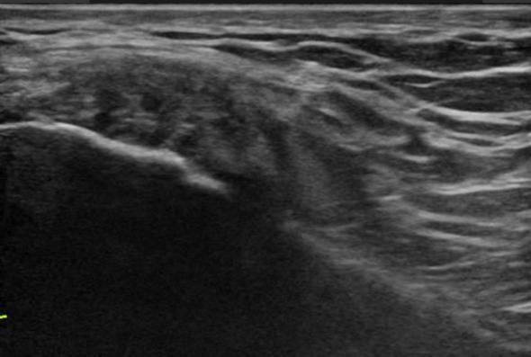 La lesión de la cintilla iliotibial es una afección común entre corredores y atletas, causando dolor en la rodilla debido a la fricción del tejido La lesión de la cintilla iliotibial es una afección común entre corredores y atletas, causando dolor en la rodilla debido a la fricción del tejido