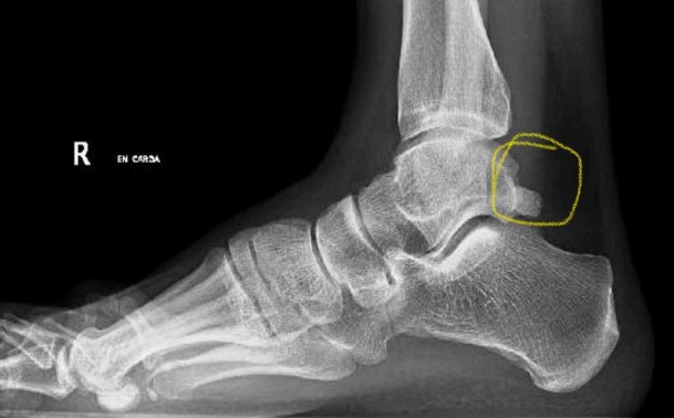 El impingement posterior de tobillo. Radiografía
