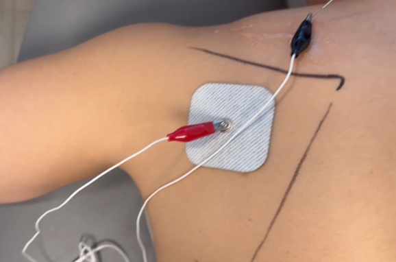 
El cuadro de neuropatía por compresión del nervio supraescapular que genera verdaderos quebraderos de cabeza a los fisios