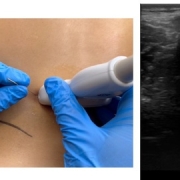 abordaje_invasivo_del_ramo_dorso_lumbar