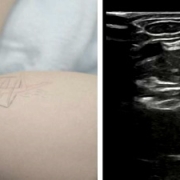 atrapamiento-nervio-cubital-imagen La neuropatía por compresión del nervio cubital, síndrome del túnel cubital, causa gran incomodidad y limita la función del brazo y la mano