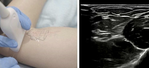 La neuropatía por compresión del nervio cubital, síndrome del túnel cubital, causa gran incomodidad y limita la función del brazo y la mano