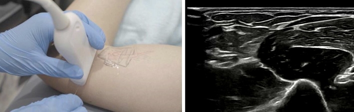 La neuropatía por compresión del nervio cubital, síndrome del túnel cubital, causa gran incomodidad y limita la función del brazo y la mano