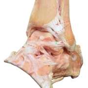 esguince_tobillo_1 El esguince de tobillo, del ligamento de peroneo-astragalino anterior (LPAA) es la lesión más frecuente cuando el tobillo sufre una inversión forzada.