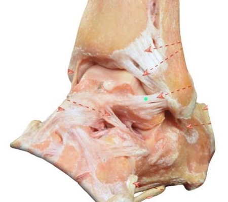 El esguince de tobillo, del ligamento de peroneo-astragalino anterior (LPAA) es la lesión más frecuente cuando el tobillo sufre una inversión forzada.