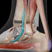 tenosinovitis_del_-tibial_posterior_1 Tenosinovitis del tibial posterior
