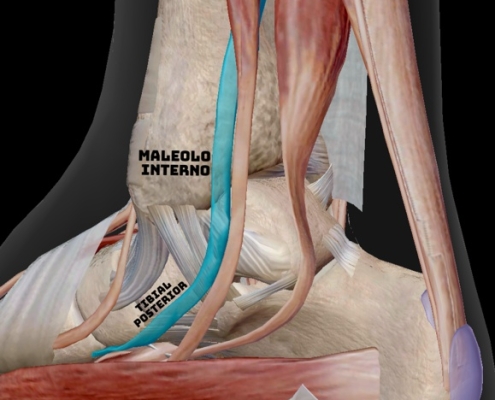 Tenosinovitis del tibial posterior