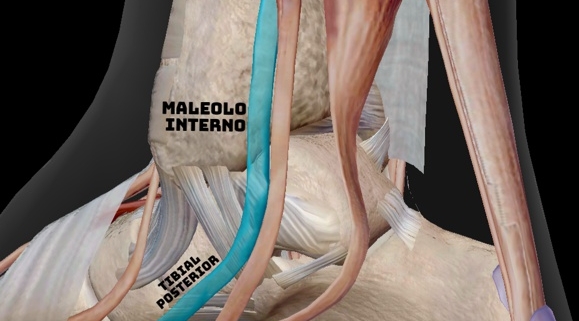Tenosinovitis del tibial posterior