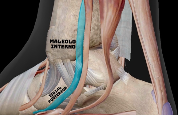 Tenosinovitis del tibial posterior