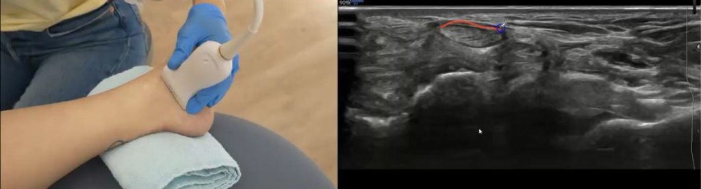 Imagen ecográfica del tibial posterior Imagen ecográfica