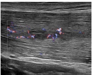 Visualización ecográfica de rotura muscular Visualización ecográfica de rotura muscular