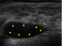 Visualización ecográfica de rotura muscular Visualización ecográfica de rotura muscular
