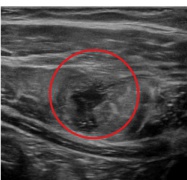 Visualización ecográfica de rotura muscular. Espacio anecoico. Visualización ecográfica de rotura muscular. Espacio anecoico.