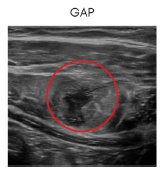 Rotura muscular, zona afectada Rotura muscular, zona afectada