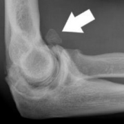 rotura-muscular-complicaciones-frecuentes-1