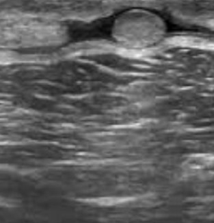 Rotura muscular, complicaciones frecuentes. Ecografía
