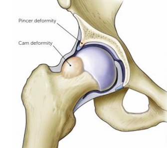 Dolor de cadera, impingement