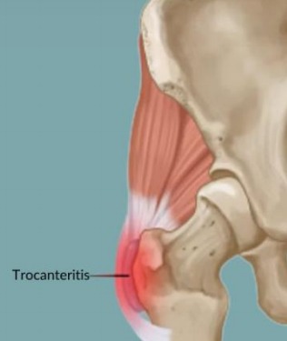 Dolor de cadera, tracanteritis