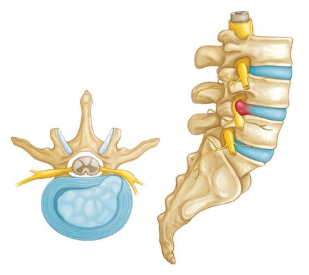 Ejemplo de hernia lumbar entre L4-L5