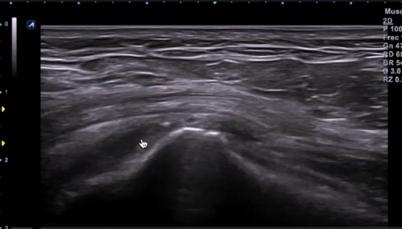 Corte longitudinal gluteo medio