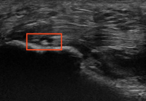 Entesopatía de la fascia plantar