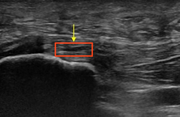 Rotura parcial de la fascia plantar