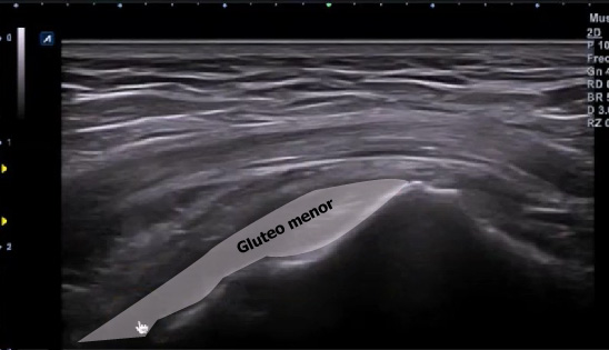 Corte longitudinal gluteo menor señalado