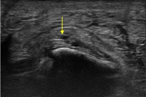 Rotura parcial de la fascia plantar