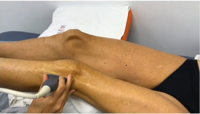 Ecografia menisco lateral corte longitudinal rodilla Ecografia menisco lateral corte longitudinal rodilla