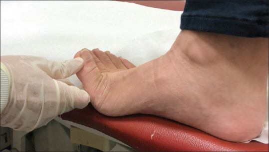 Exploración física: test fascitis plantar