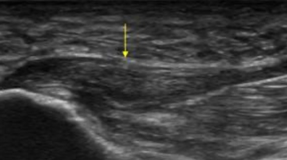 Fascitis (fasciopatía) plantar