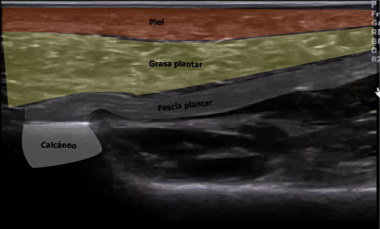 imagen ecografica fascia plantar detallada