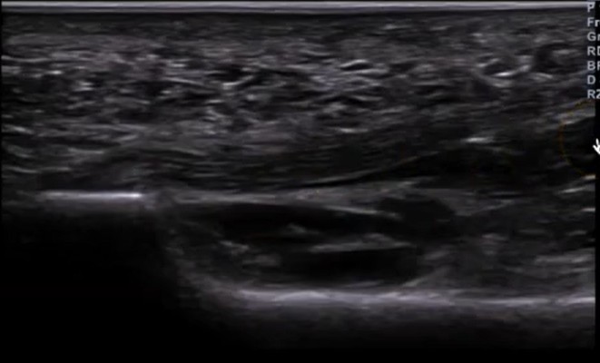 Ecografía del pie: evaluación de la fascia plantar