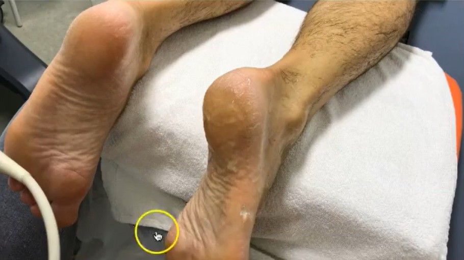 Ecografía de la fascia plantar