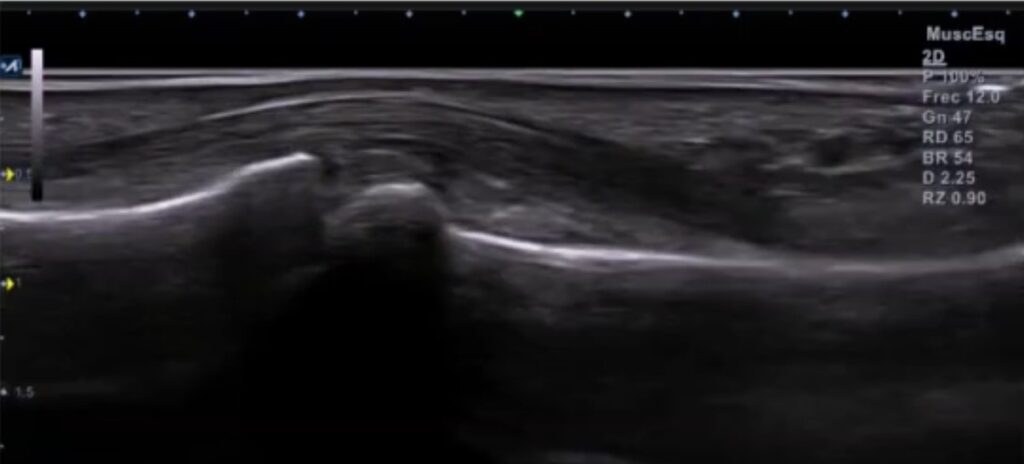 Corte longitudinal ecografía flexor profundo y superficial Corte longitudinal ecografía flexor profundo y superficial